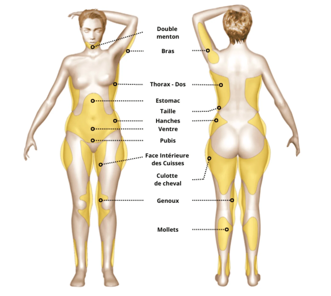 Schéma des zones de liposuccion, de face et de dos : double menton, bras, thorax et dos, estomac, taille, hanches, ventre, pubis, face intérieure des cuisses, culotte de cheval, genoux et mollets