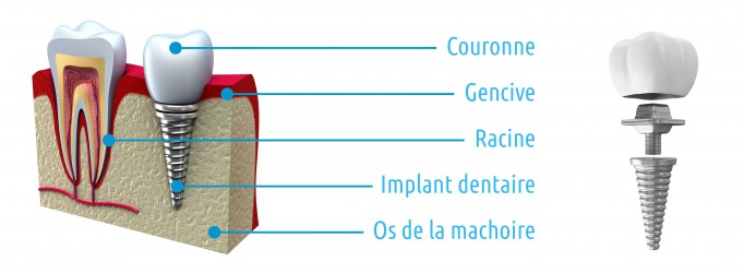 Implants dentaires à Bruxelles à la Clinique Churchill