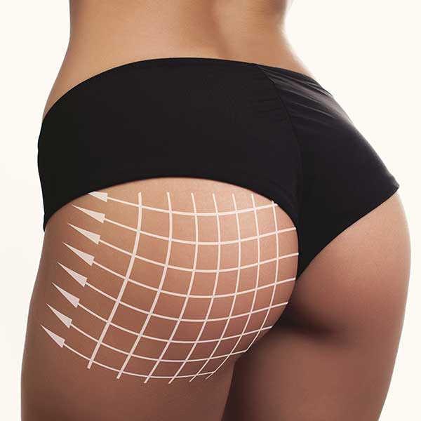 FESSES : Lipofilling (BBL) - implants - acide hyaluronique